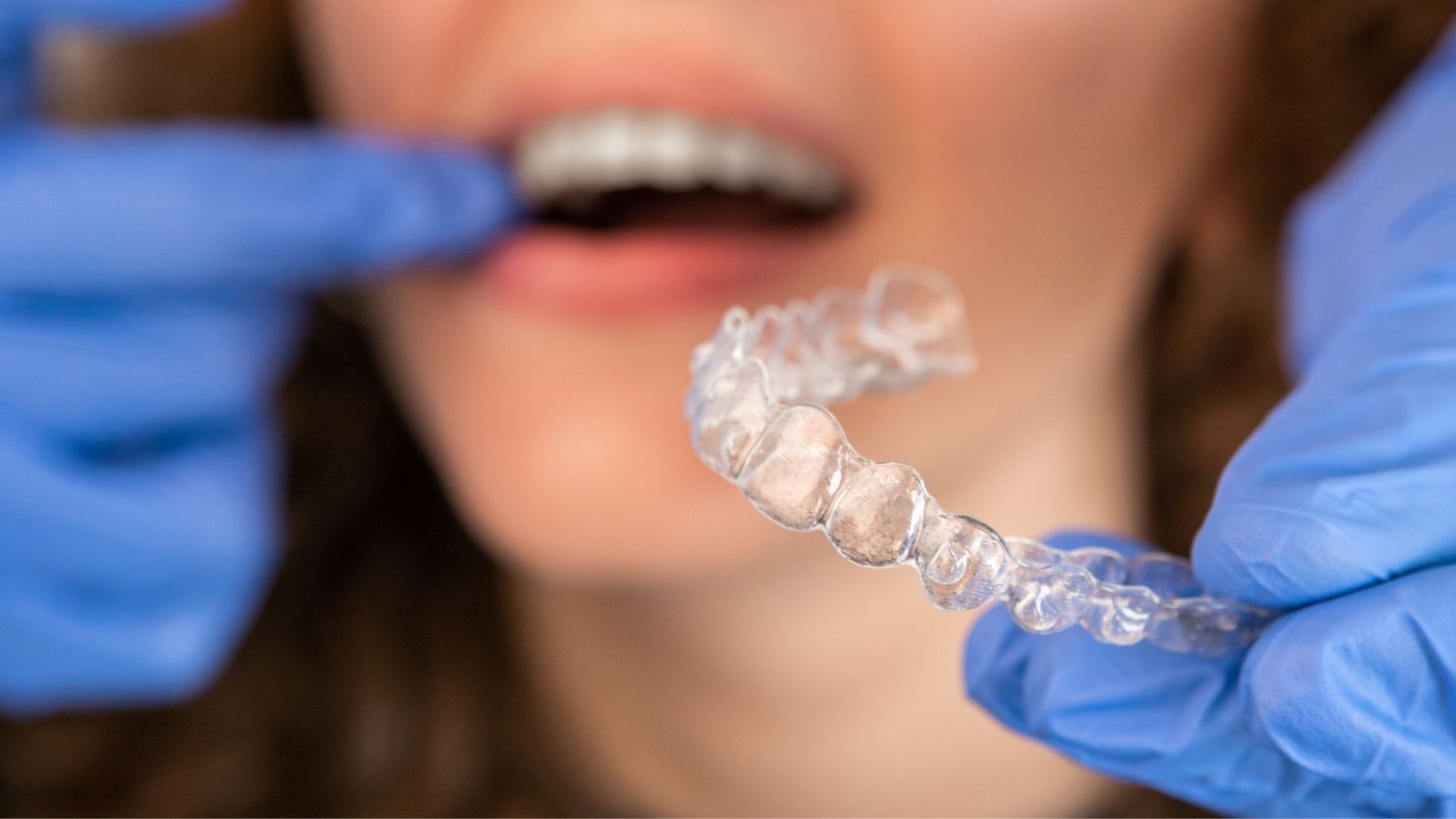 Profissional a colocar um alinhador transparente nos dentes de uma paciente